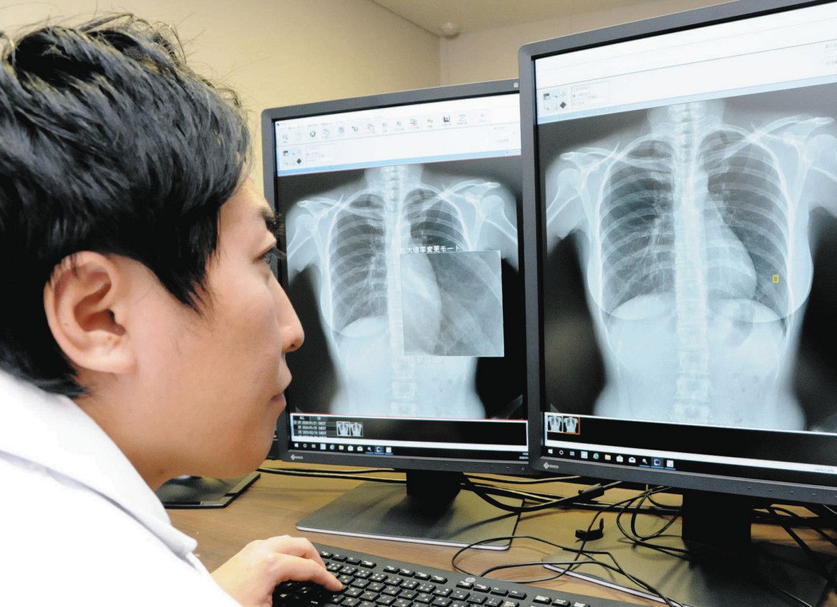 医療現場でのAI活用進む エックス線画像から異常指摘「医師の心の負担軽くなった」 - 中日新聞Web