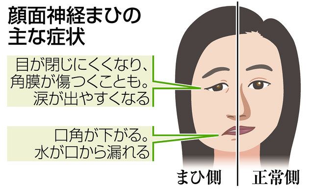 目 ヘルペス 英語