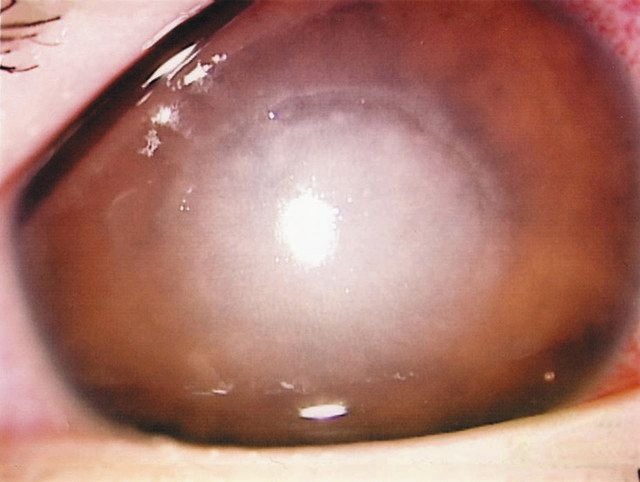 アカントアメーバ　角膜炎　抗菌薬が効きにくく失明することも（水谷眼科診療所提供） 