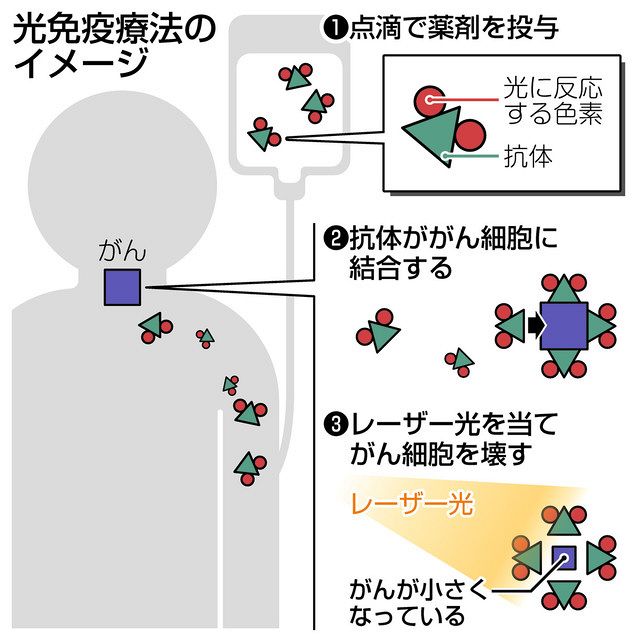頭頸部悪性腫瘍に対する特異的免疫療法 自己癌キラ-細胞の試験管内誘導と治療への応用/文光堂/石川哮（単行本） 光の作用で、がん細胞を破壊 福井大病院が県内初の光免疫療法 ：日刊
