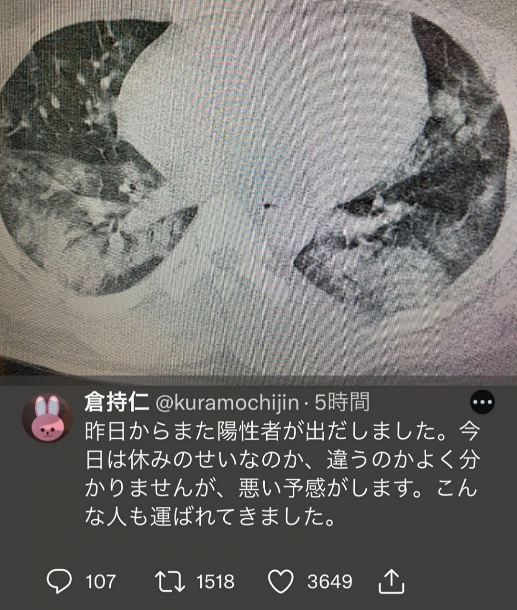倉持院長が公開した真っ白な肺のCT画像（Twitterより）