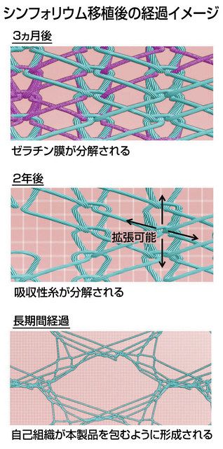 心・血管修復パッチ承認 福井経編興業が開発 再手術のリスク低減 