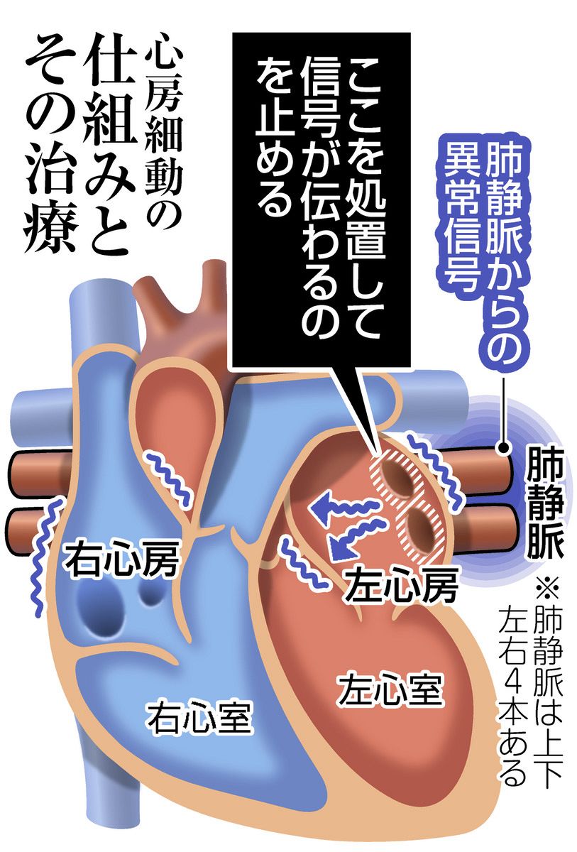 心房細動に攻めの医療 AIで「隠れ細動」可能性を指摘 ：中日新聞Web