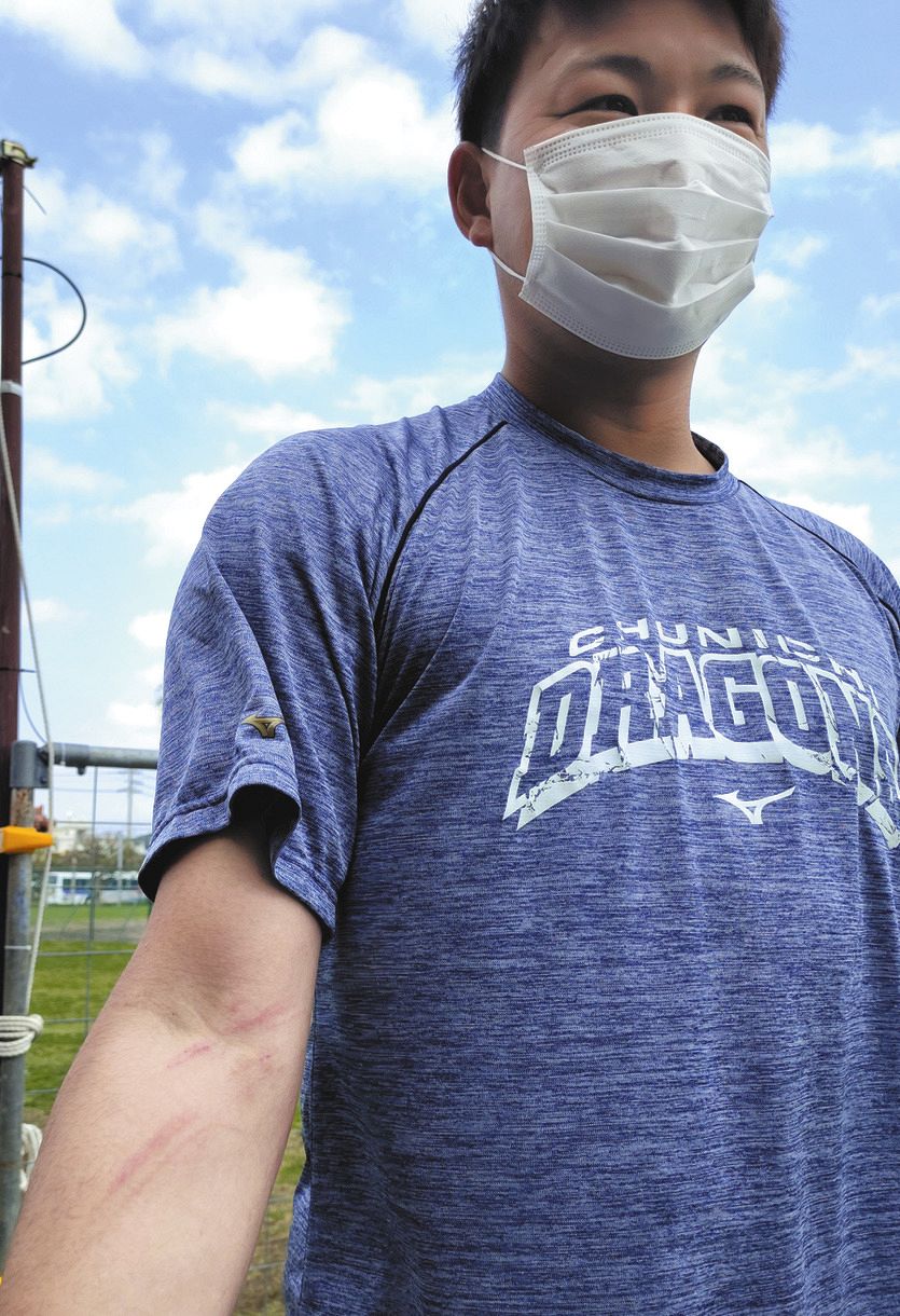 写真 吉兆 田島の右肘にあらわれた みみず腫れ 中日スポーツ 東京中日スポーツ