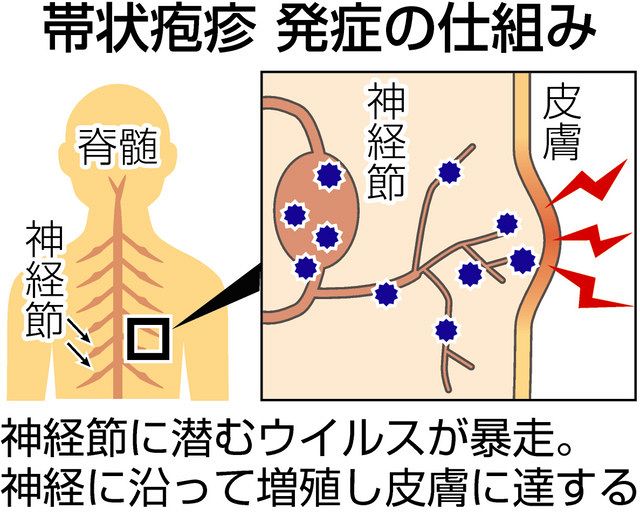 加齢で増加、帯状疱疹 ワクチンで予防は可能：中日新聞Web