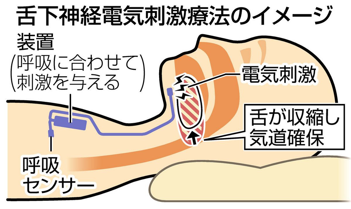 睡眠時無呼吸症候群（SAS）の治療｜CPAP療法｜香川県高松市の