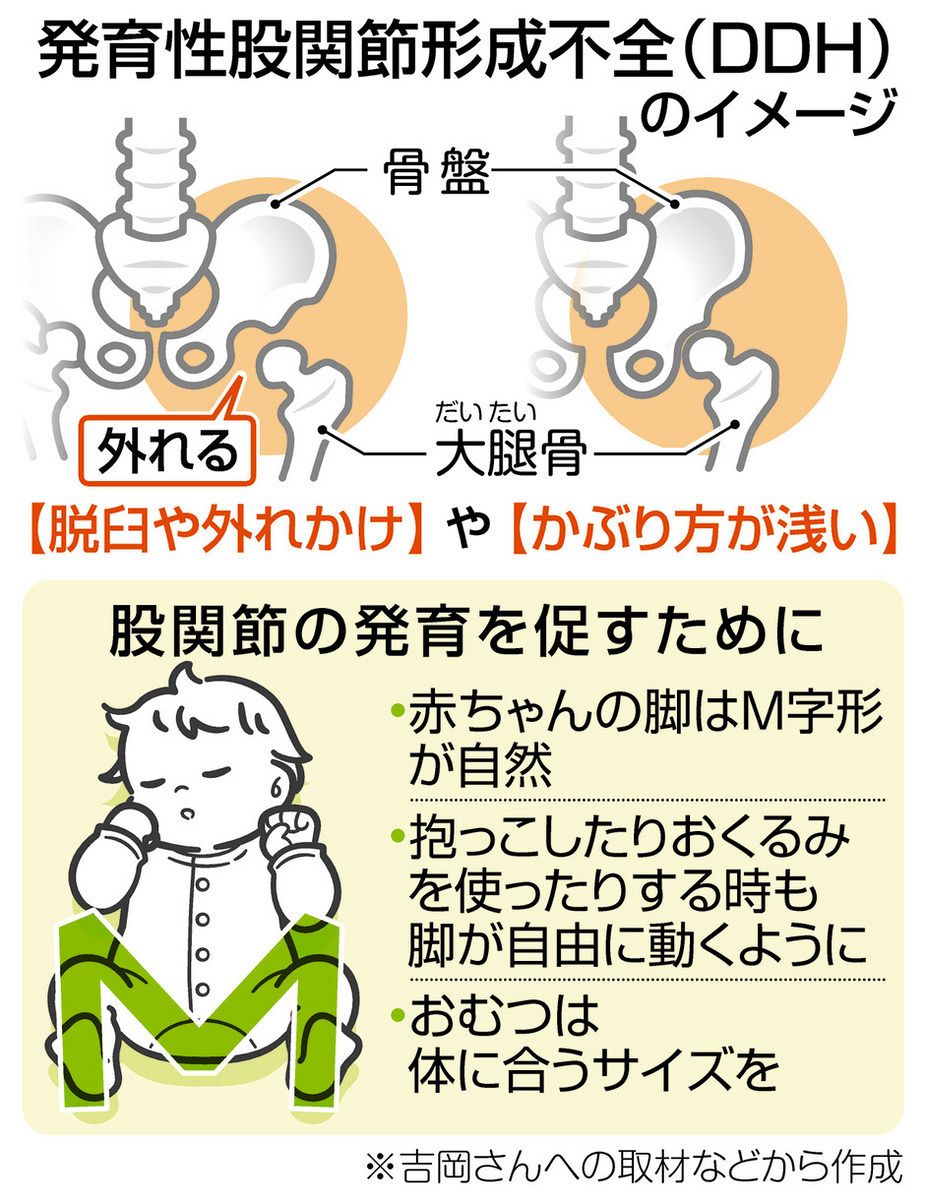脱臼など乳幼児の股関節異常 超音波画像で早期発見目指す：中日新聞Web