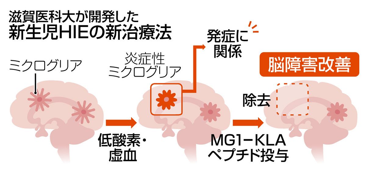 脳性まひの主原因「新生児HIE」に新治療法 滋賀医科大学