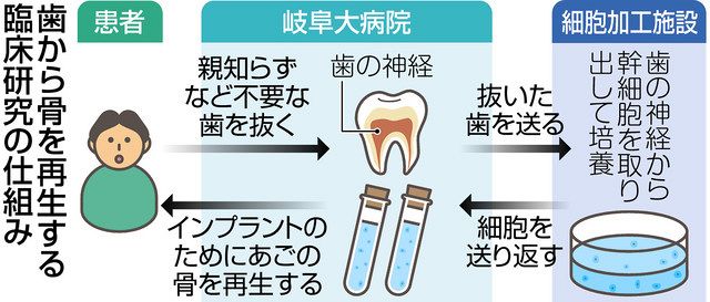歯からあごの骨再生 岐阜大病院、人工歯根など臨床研究へ：中日新聞Web