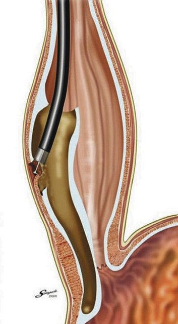 食道の粘膜の下の筋層を切開する手術「ポエム」のイメージ図（Ｉｎｏｕｅ　Ｈ．　Ｊ　Ａｍ　Ｃｏｌｌ　Ｓｕｒｇ．　２０１５提供）　