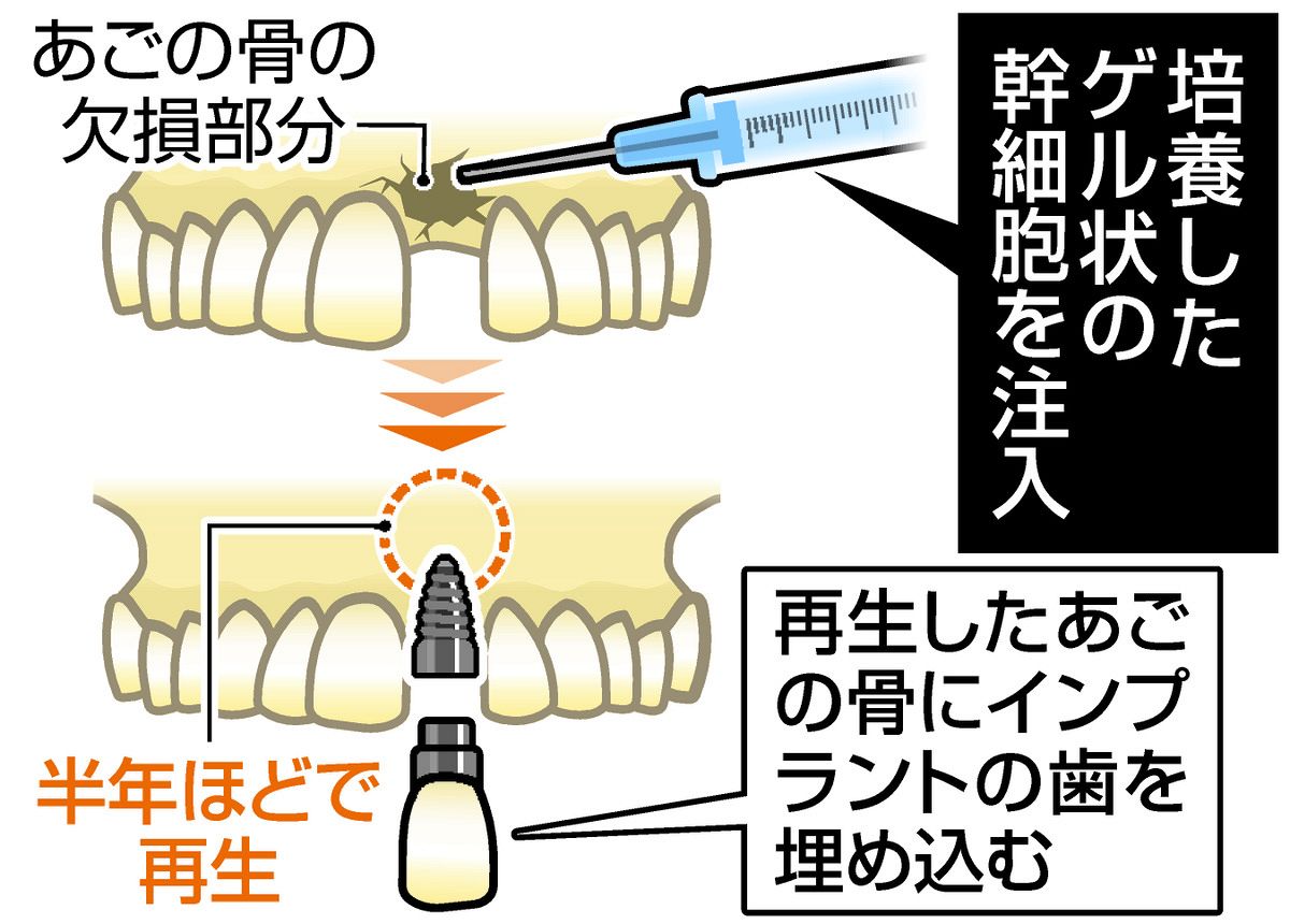 世界初、歯の神経から顎の骨を再生へ 岐阜大病院、既に4件の手術実施