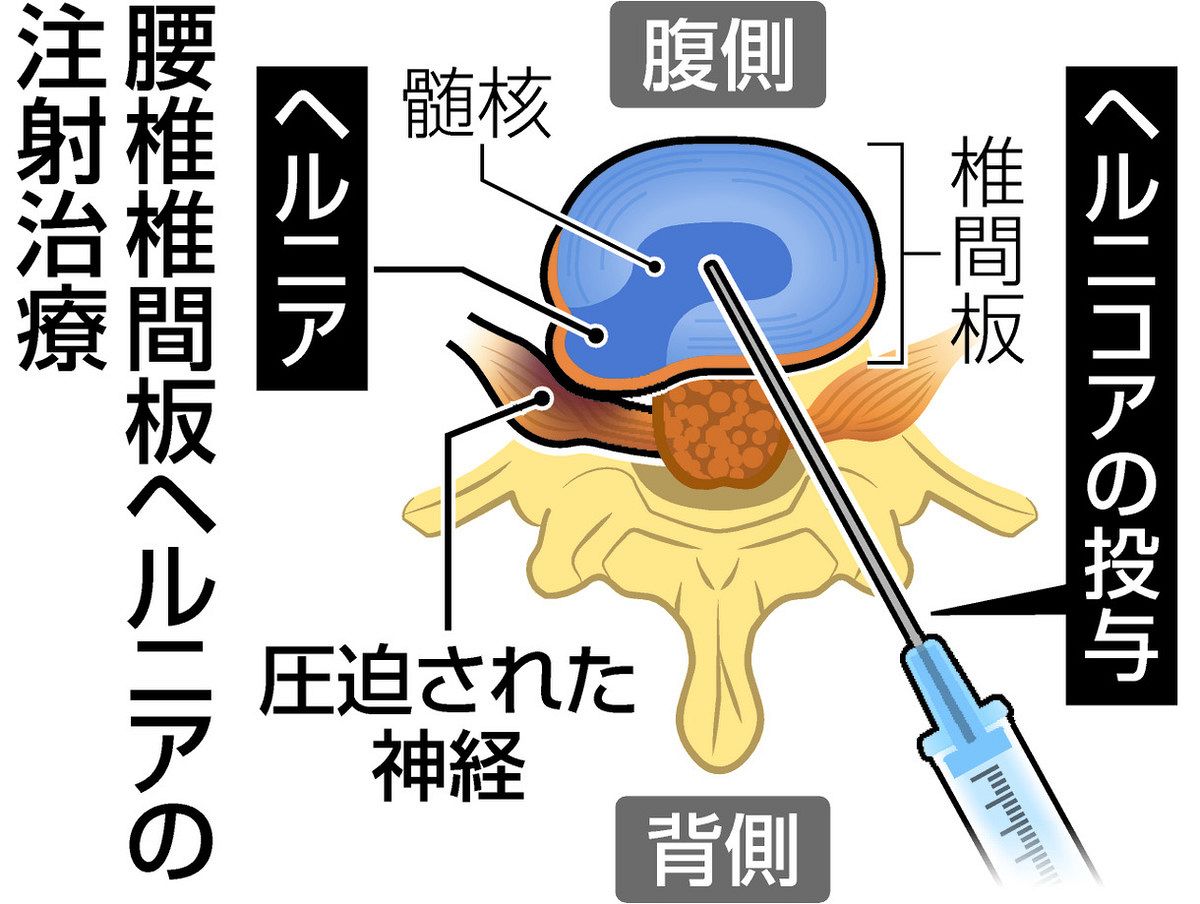 ヘルニア 椎間板ヘルニア注射で改善 日帰り可能、負担少ない「ヘルニコア」投与