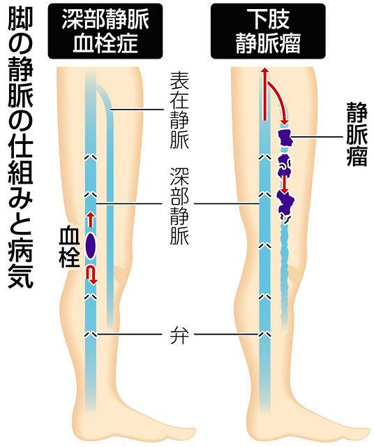 血液逆流する下肢静脈瘤 血栓性静脈炎の併発増 中日新聞web