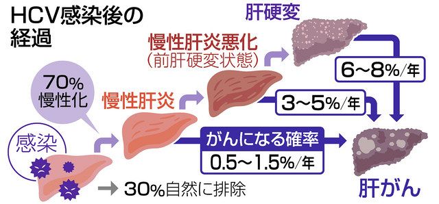C型肝炎 治療法進化 非代償性肝硬変も服薬可能に：中日新聞Web