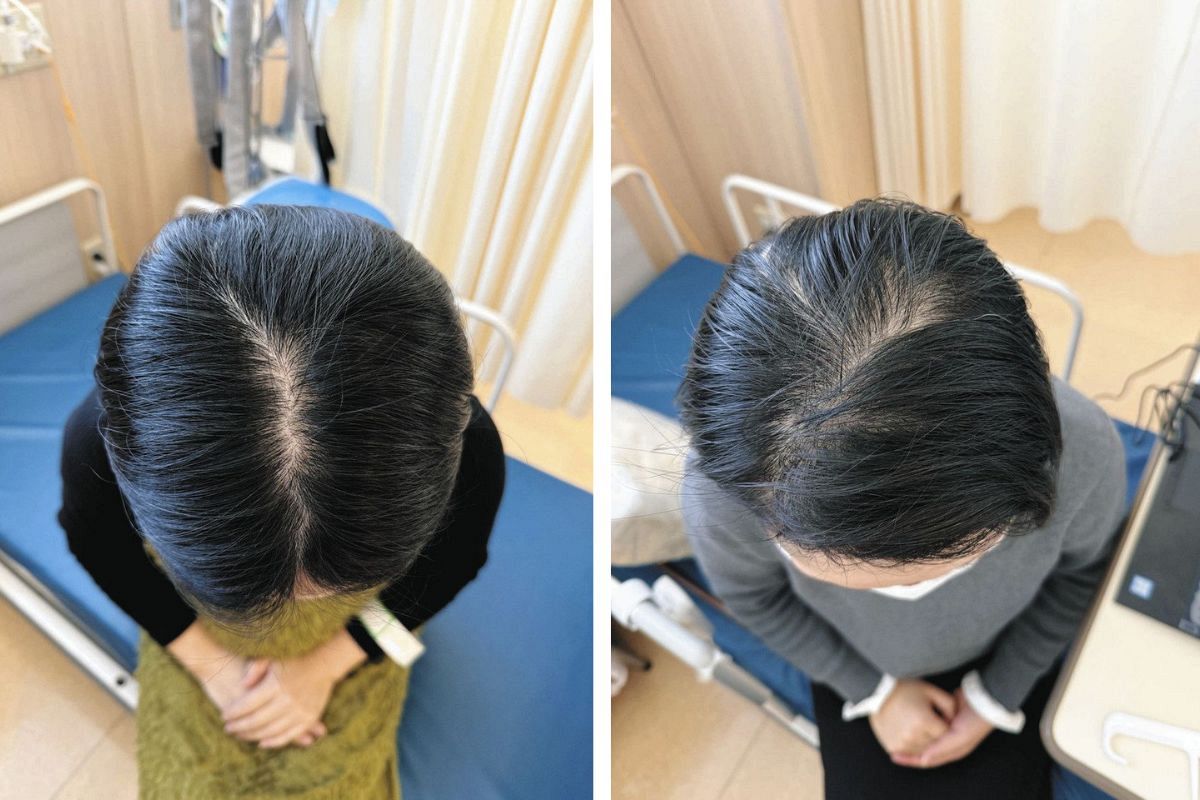 アイスジャパン がん患者の脱毛を抑制する頭皮冷却帽子を開発