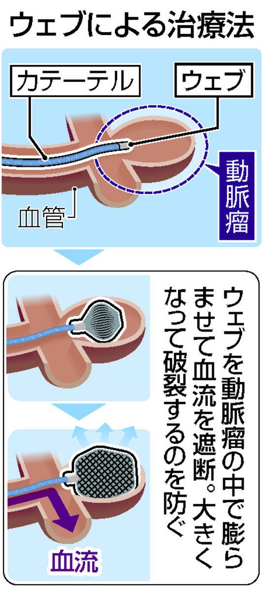 脳動脈瘤の新治療、金属器具「ウェブ」で実績 血流遮断し破裂防ぐ ：中