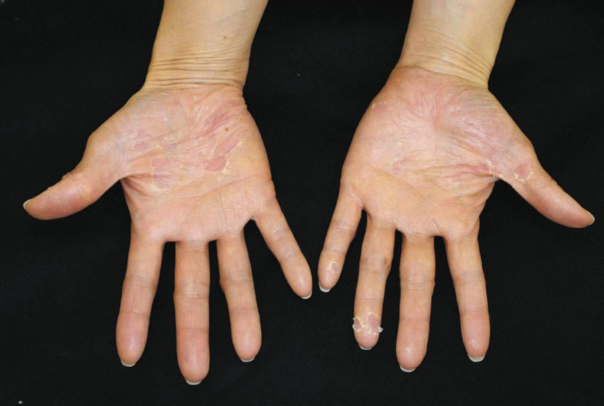 手や足に水膨れ「掌蹠膿疱症」で皮膚科と歯科が連携 歯周炎治療で症状