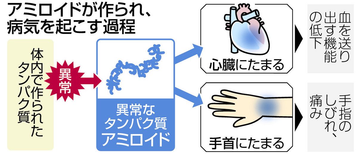 診断ラグ」短縮へ AIで画像分析 心臓の希少疾患で ：中日新聞Web