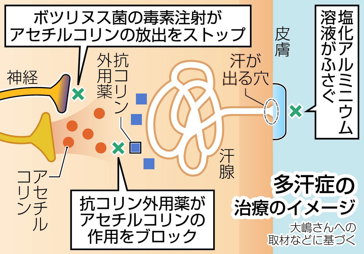 手のひらに、脇の下に大量の汗をかく「多汗症」 悩んでいる人は専門