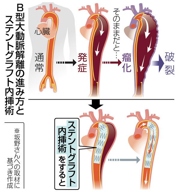 大動脈解離の予後、発症早期の「ステントグラフト」で改善も:中日新聞Web 大動脈解離の予後、発症早期の「ステントグラフト」で改善も:中日新聞Web