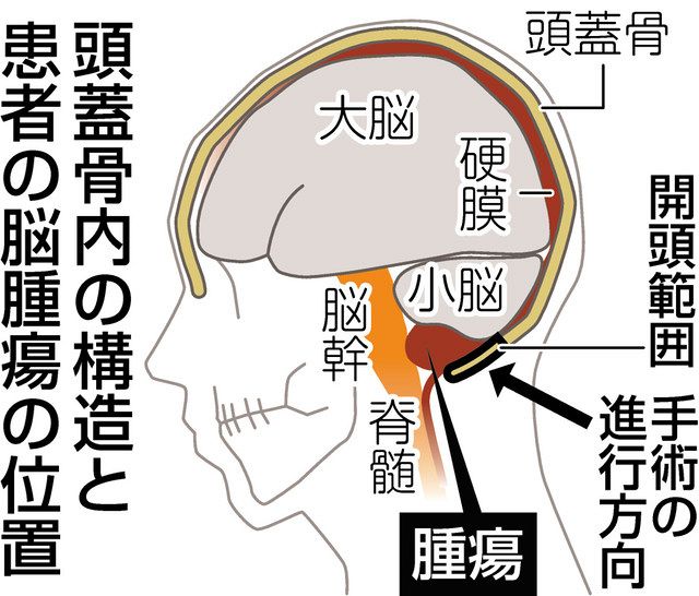 脳腫瘍の内視鏡手術 「外視鏡」も使い負担軽減：中日新聞Web