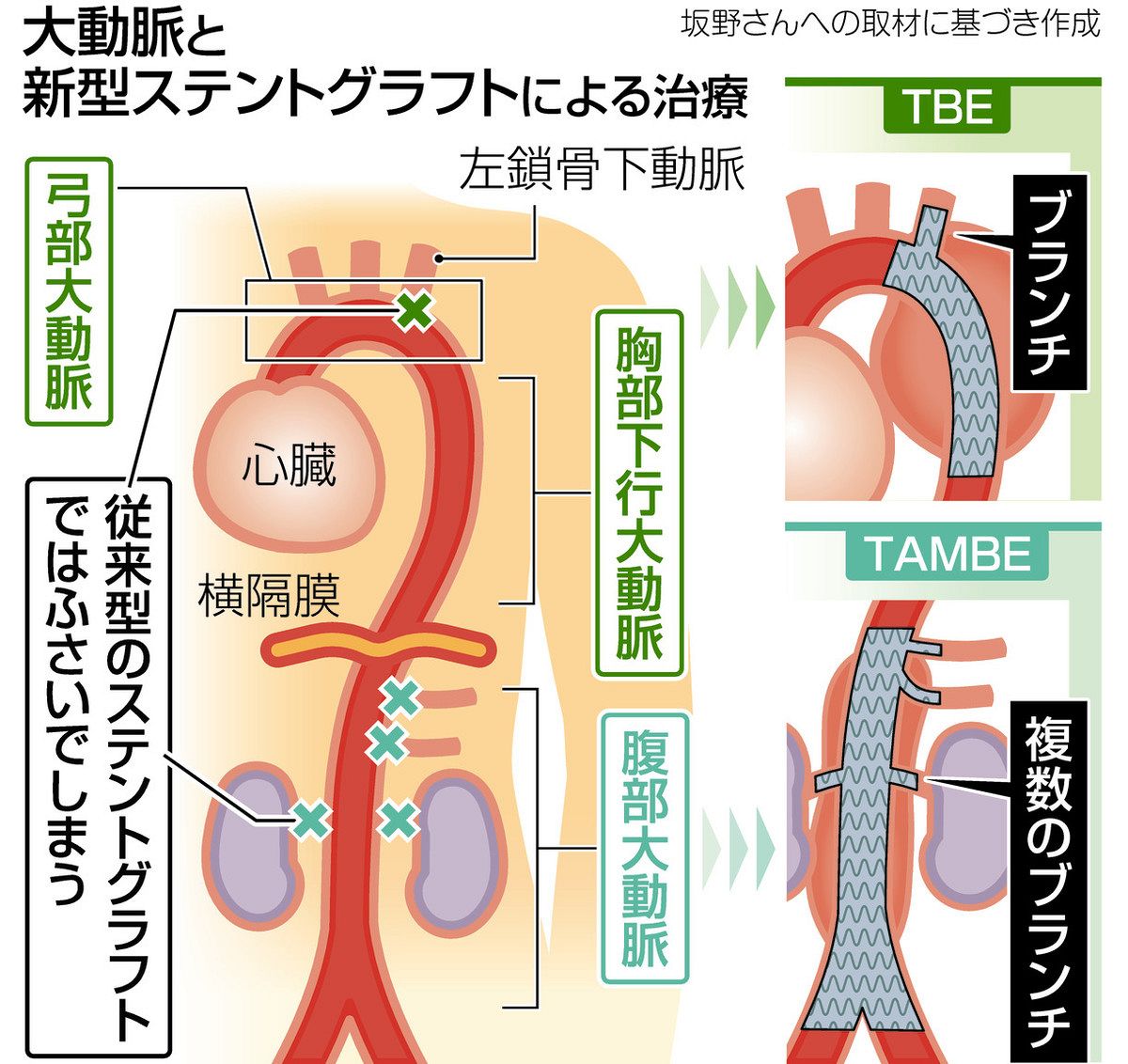 大動脈瘤 ステントグラフト治療 広がる 弓部と胸腹部 ：中日新聞Web