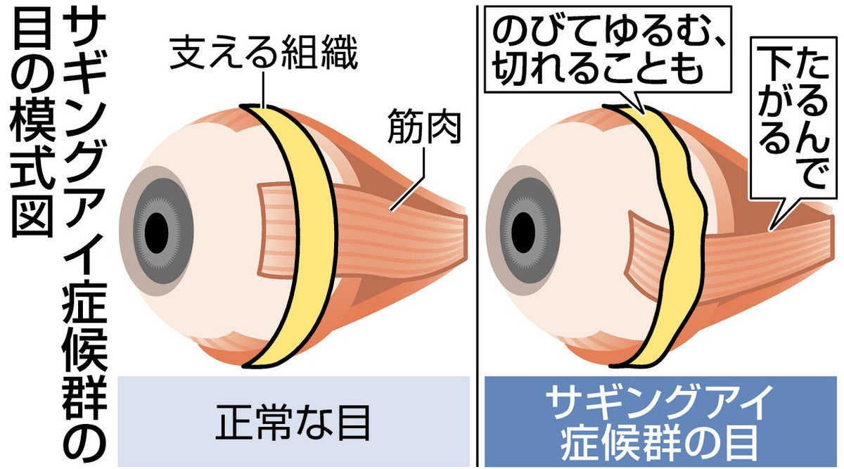 高齢期の斜視甘く見ないで！「サギングアイ症候群」かも 転倒や車の