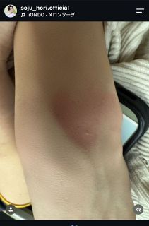 【実際の投稿】“アイドリン分泌⁉”、堀蒼寿の“奇跡”報告、「iiONDO」同僚・畑駿平の腕に浮かび上がったピンクハート