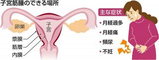 子宮筋腫ある人増加　腹腔鏡手術で負担軽減　