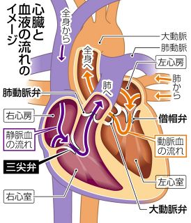 高齢者の１０人に１人が発症する心臓弁膜症　治療の選択肢広がり、負担も少なく