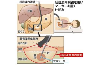 低負担・正確・安全「膵臓がん」治療に新手法　豊橋の成田記念病院で導入進む